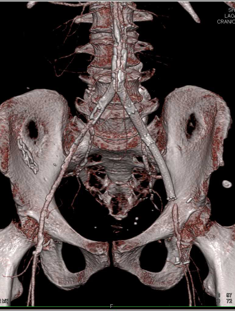 Patents Stents in Superior Mesenteric Artery (SMA) and Celiac Arteries - CTisus CT Scan