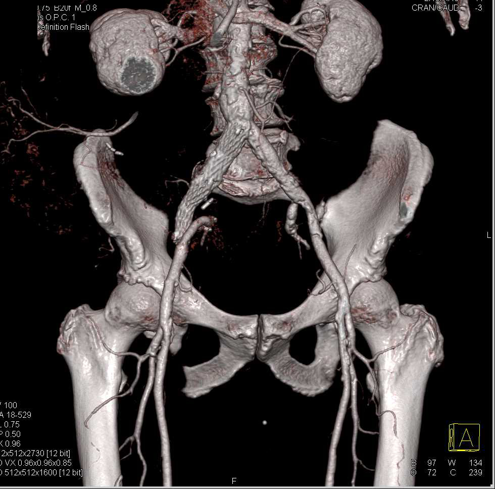 CTA with Stent in Right Common Iliac Artery - Vascular Case Studies ...