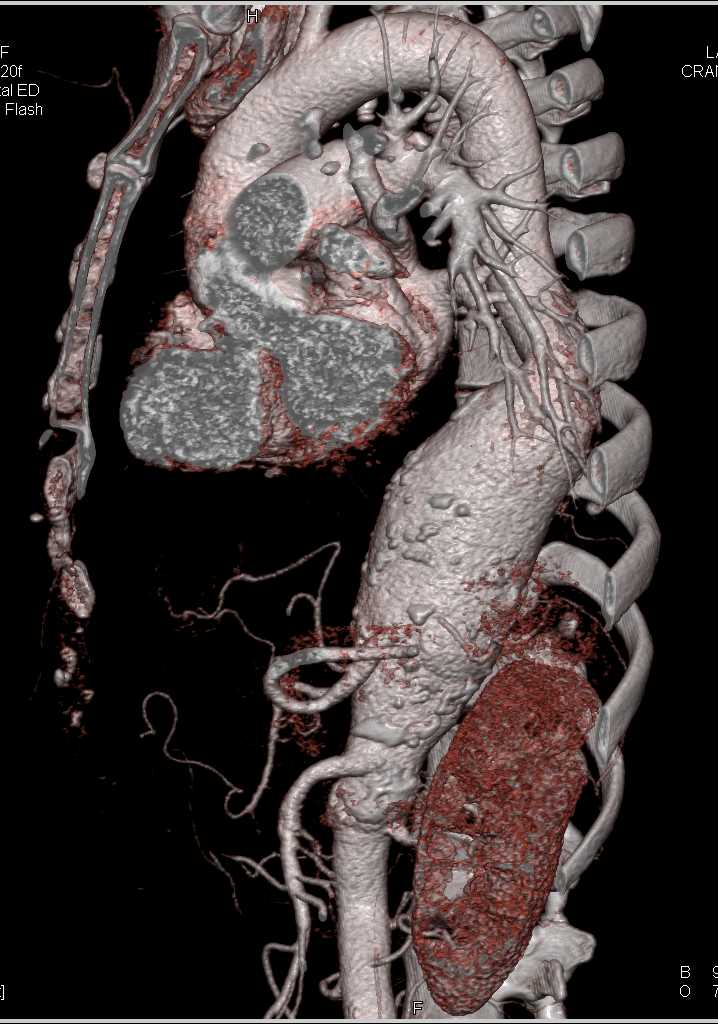 Aneurysm Lower Thoracic and Upper Abdominal Aorta - CTisus CT Scan