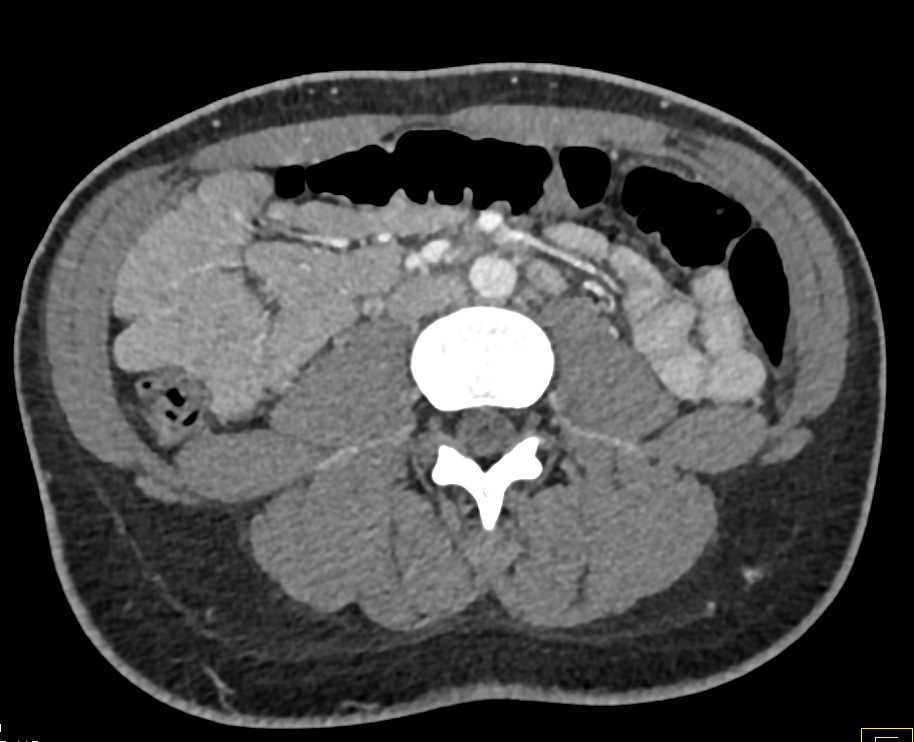 Clot in Right and Left Gonadal Veins - CTisus CT Scan