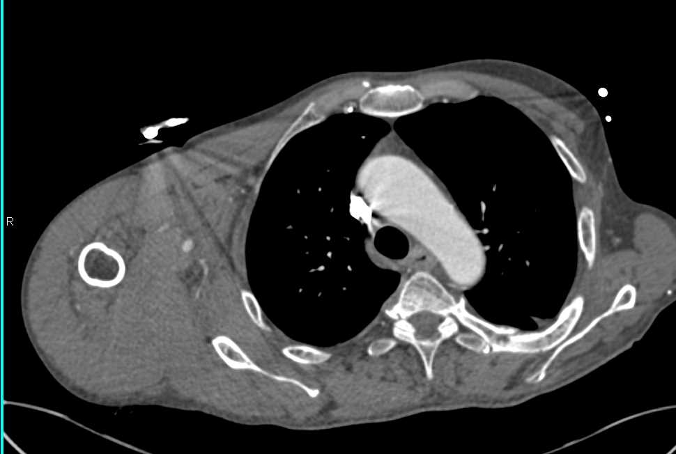 Occlusion of the Right Brachial Artery and Hematoma - CTisus CT Scan