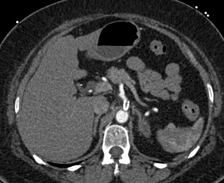 Occluded Stent in the Celiac Artery - CTisus CT Scan