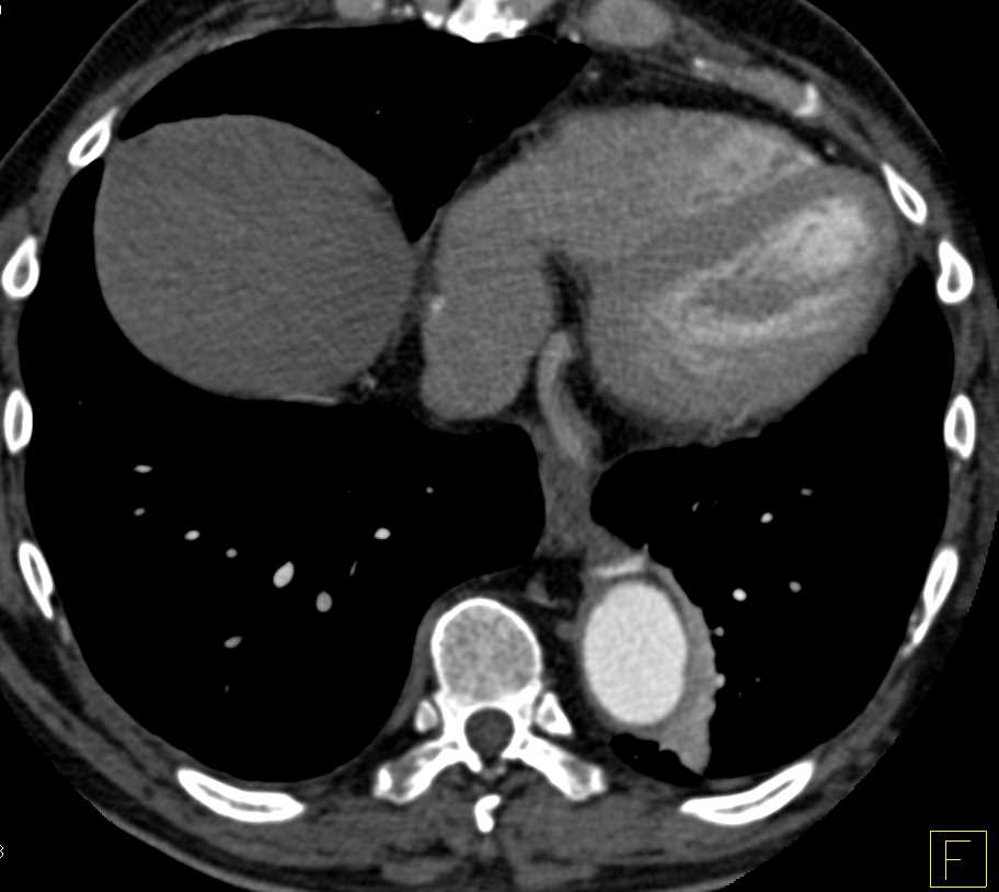 Dissection of the Abdominal Aorta - CTisus CT Scan