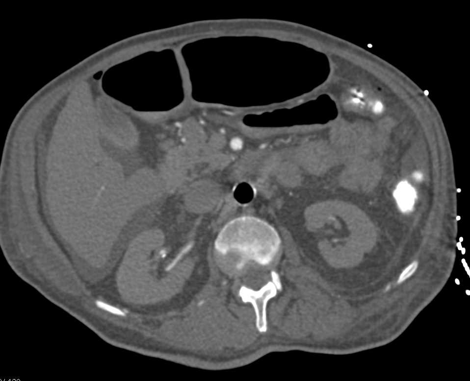 Intra-Aortic Balloon Pump Simulates Air in Lumen of Aorta - CTisus CT Scan