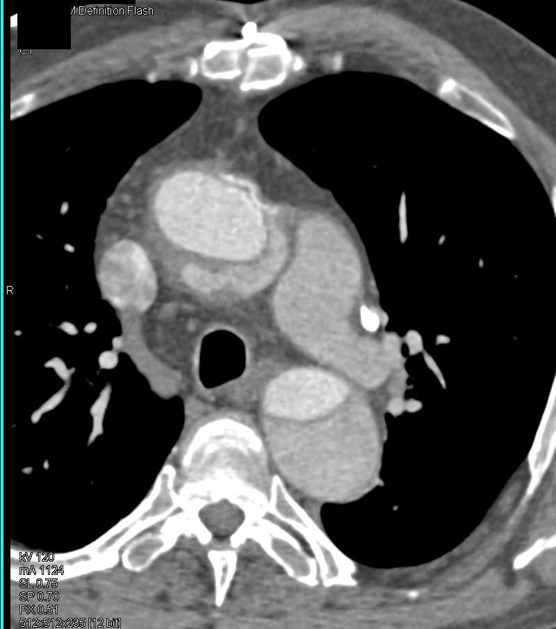 Type A Dissection - CTisus CT Scan