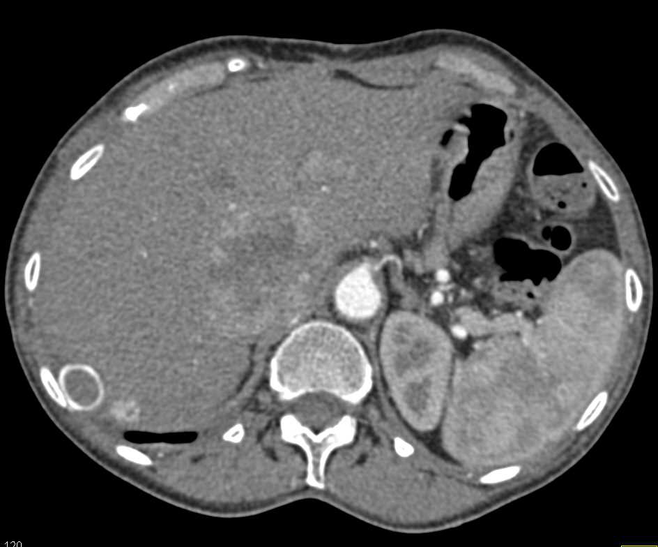 Inferior Vena Cava (IVC) Bypass Graft with Adrenal Carcinoma - CTisus CT Scan