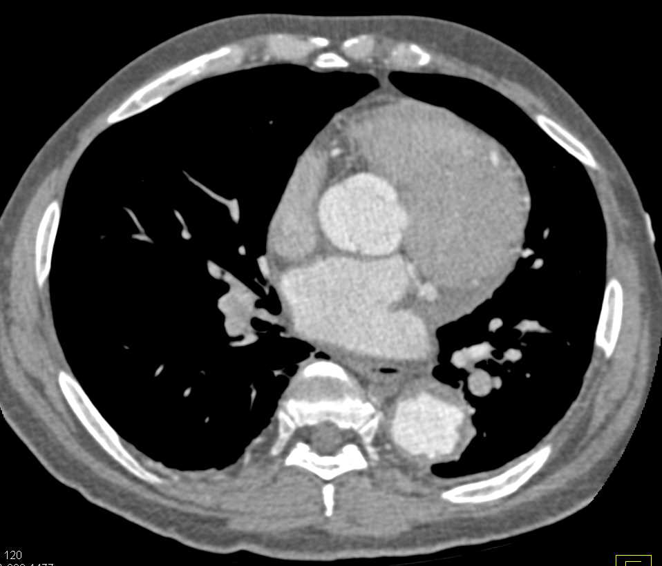 Aortic Aneurysm Thoracic Aorta - CTisus CT Scan