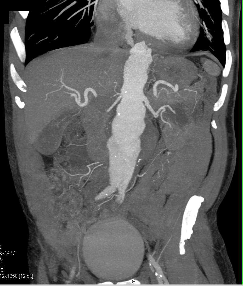 Aortic Aneurysm Thoracic Aorta Vascular Case Studies Ctisus Ct Scanning