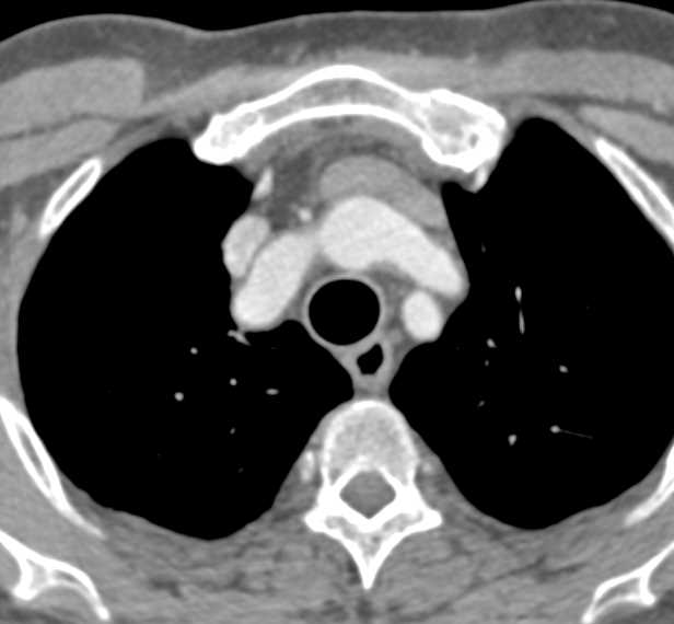 Aortic Aneurysm Thoracic Aorta - CTisus CT Scan