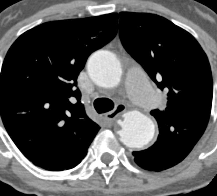 Aortic Aneurysm Thoracic Aorta with Ulcerations - CTisus CT Scan