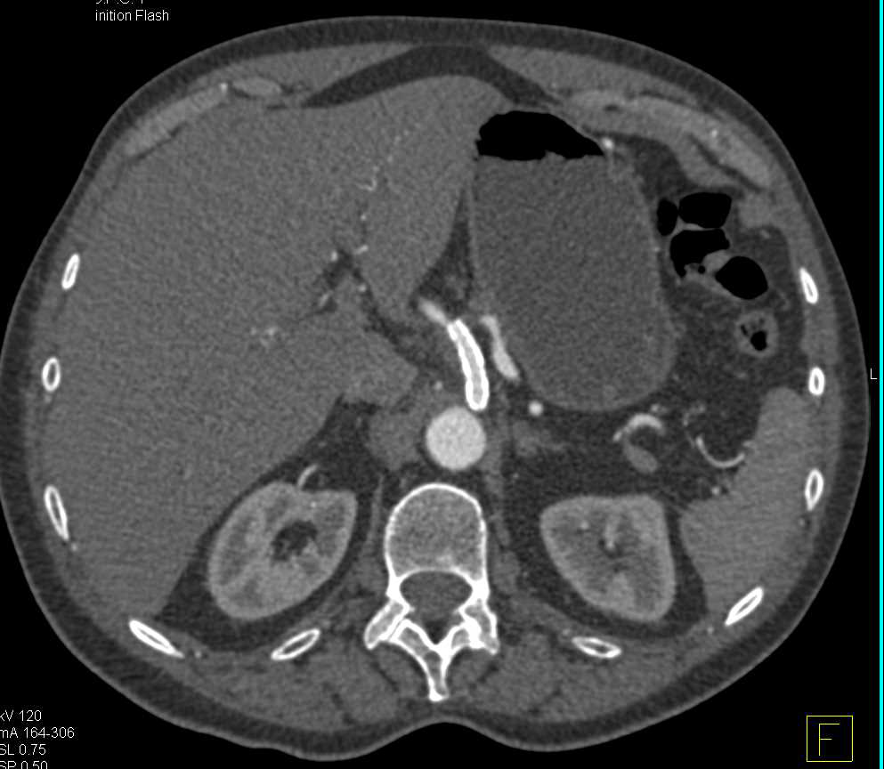 Patent Stent in the Celiac Artery - CTisus CT Scan