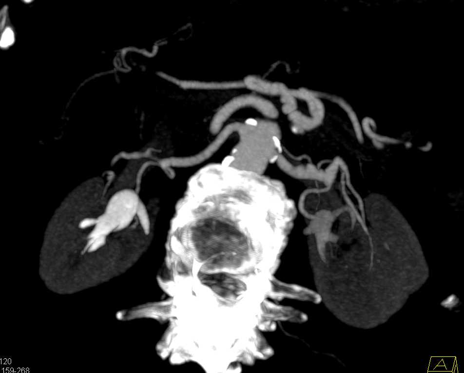 Fibromuscular Dysplasia (FMD) Left Renal Artery and the SMA - CTisus CT Scan
