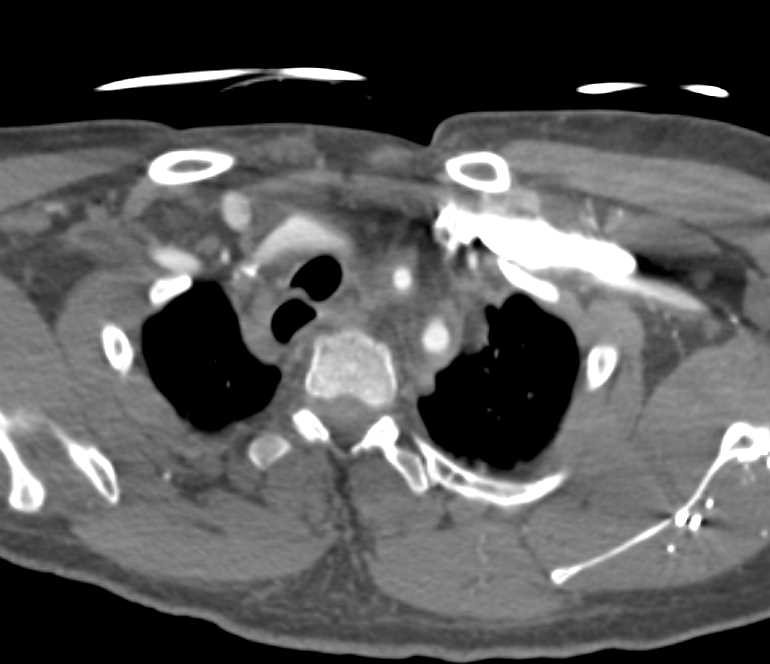 Vasculitis Probably Takayasu's Involve Aortic Arch and Branch Vessels off the Arch - CTisus CT Scan