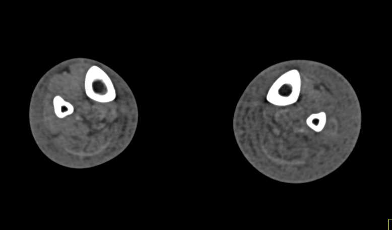 CTA Runoff with DE: Extensive Plaques in the Superficial Femoral Artery (SFA) and Trifurcation - CTisus CT Scan