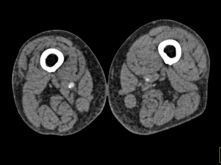 CTA DE Runoff with Peripheral Vascular Disease - CTisus CT Scan