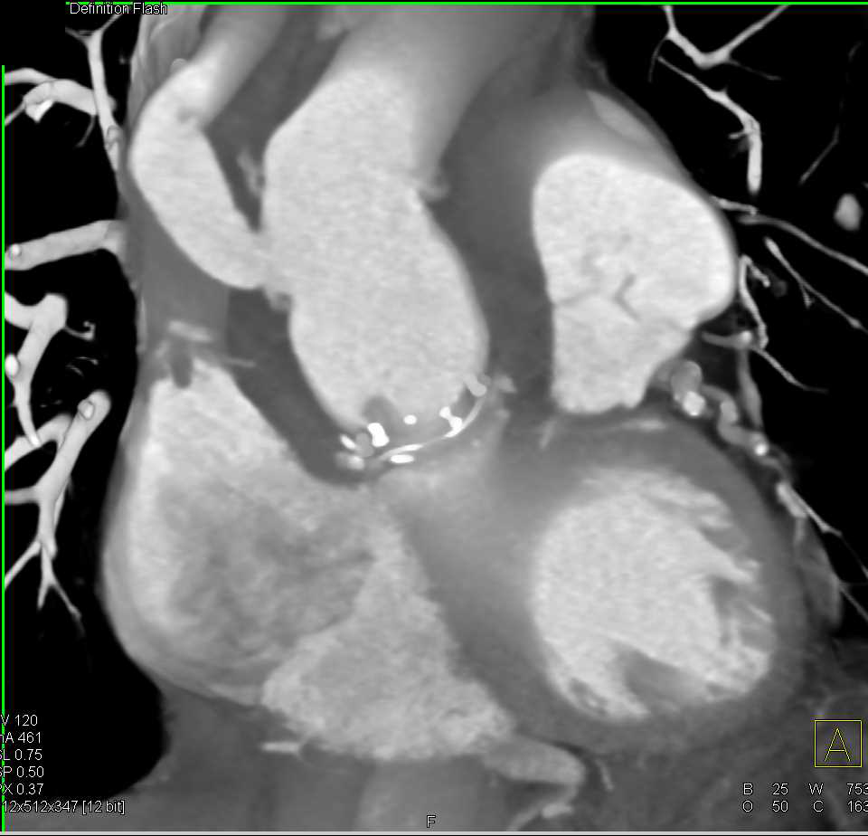 Aneurysm Repair with Multiple Collaterals in the Abdomen in an Unusual Pattern - CTisus CT Scan