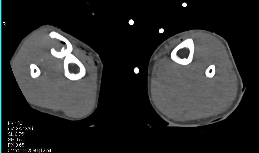 Fractures with Occlusion of the Superficial Femoral Artery (SFA) due to Trauma - CTisus CT Scan