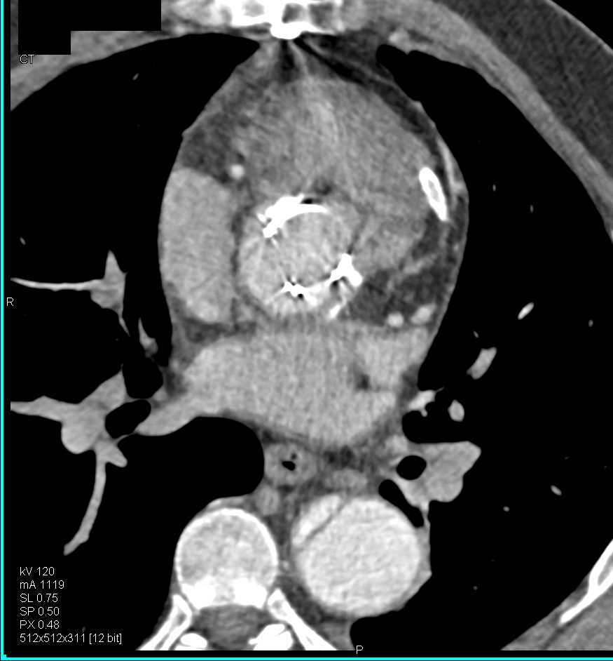 CTA with Ascending Aorta Repair and Dissection Extends Down Descending Thoracic Aorta - CTisus CT Scan