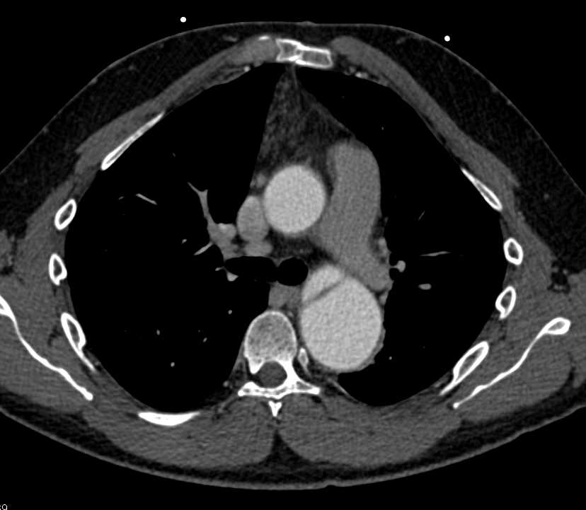 CTA with Ascending Aorta Repair and Dissection Extends Down Descending
