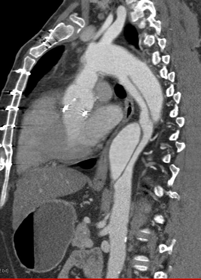 CTA with Ascending Aorta Repair and Dissection Extends Down Descending
