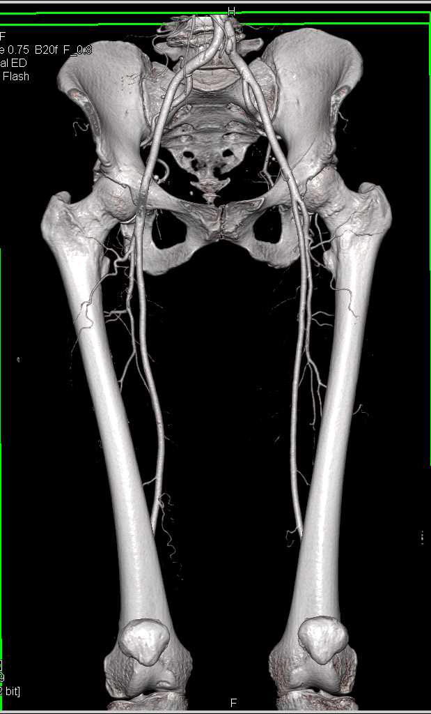 CTA Runoff with No Evidence of Vessel Stenosis - CTisus CT Scan