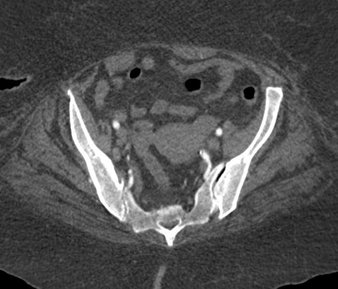 CTA with Occluded Right Superficial Femoral Artery - CTisus CT Scan