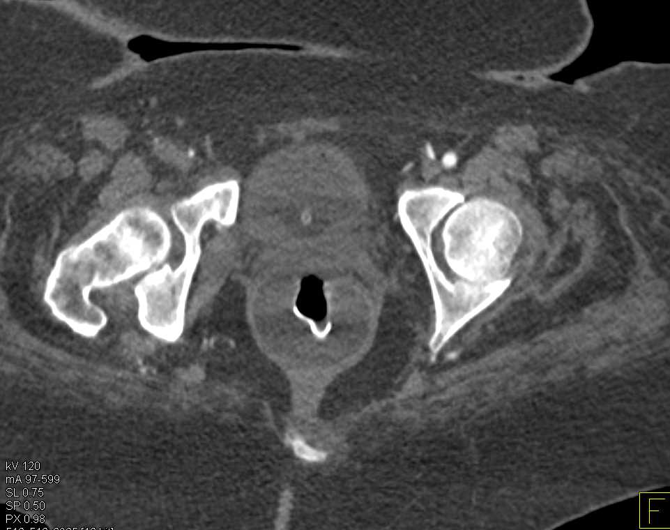 CTA with Occluded Right Superficial Femoral Artery - CTisus CT Scan