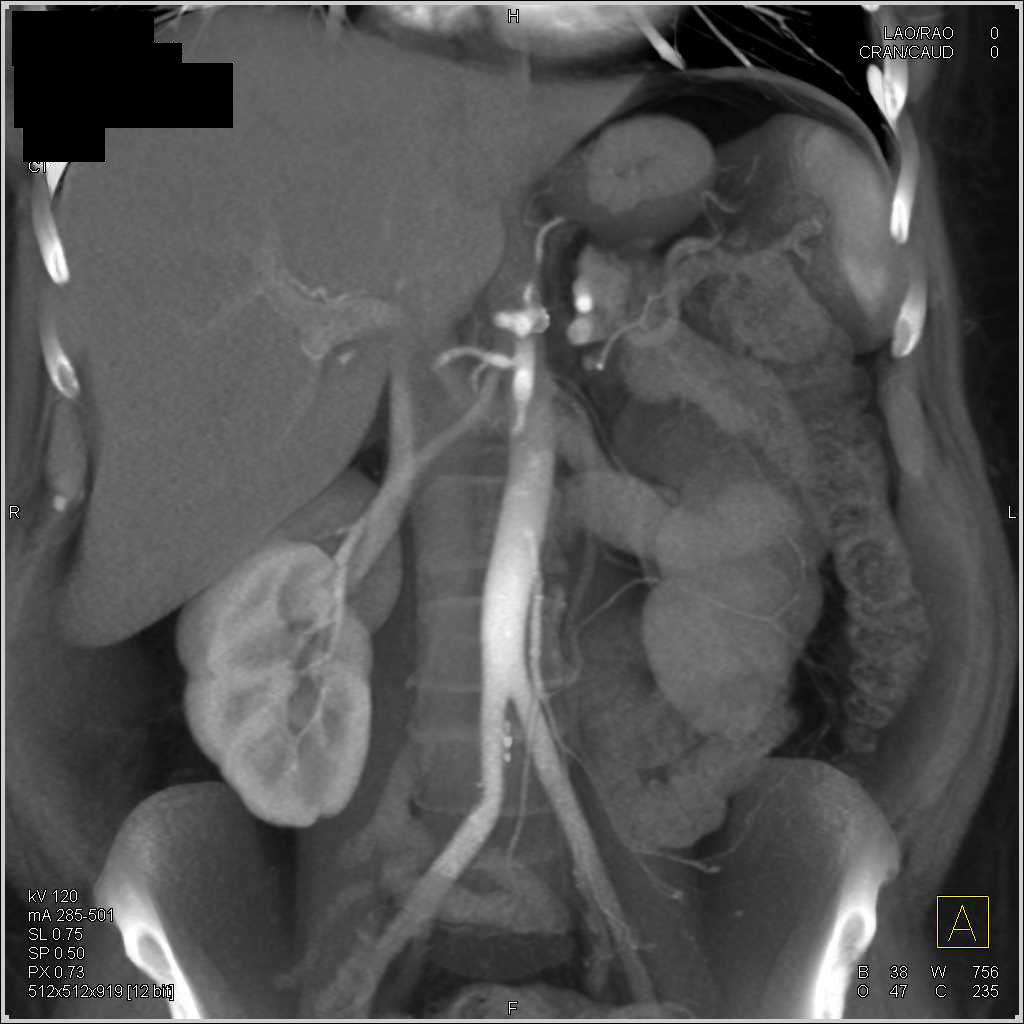 Occluded Stent in the Celiac Artery - CTisus CT Scan