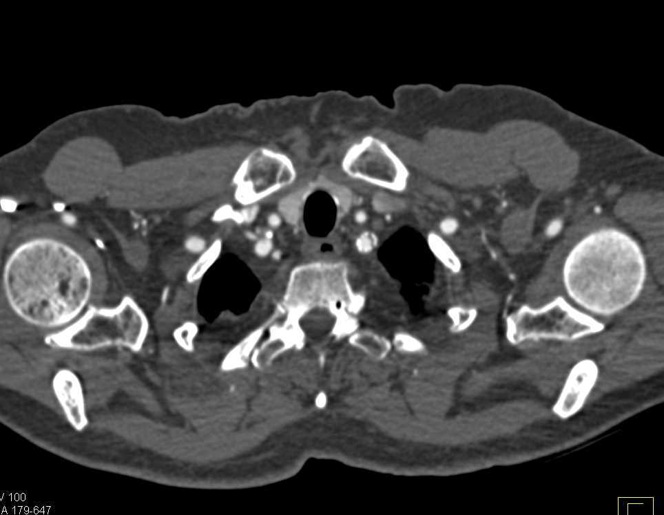 Stent in Left Subclavian Artery - CTisus CT Scan