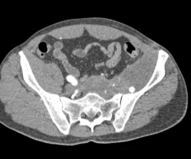 Reconstructed Left External Iliac Through Superficial Femoral Artery (SFA) in Patient with Tumor Infiltration into the Pelvis - CTisus CT Scan