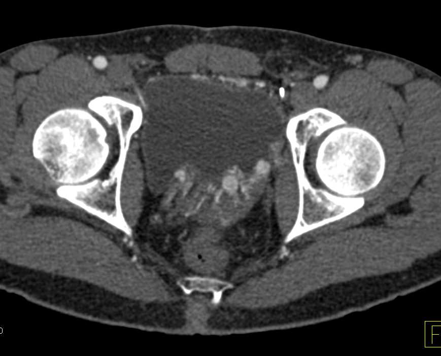 Vascular Collaterals in the abdomen - CTisus CT Scan