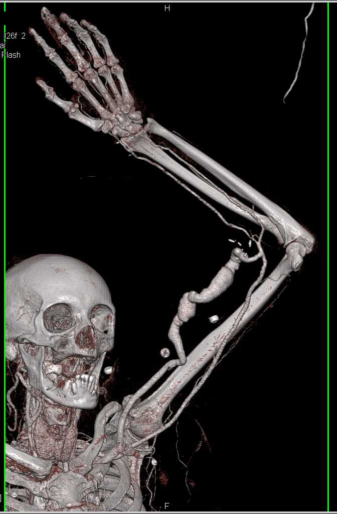 CTA Map of Arteriovenous (AV) Fistulae in Left Upper Arm - CTisus CT Scan