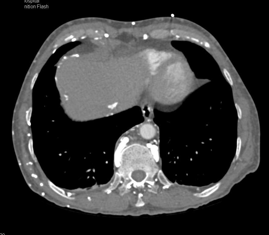 CTA with Chest Wall and Paraspinal Collaterals - Vascular Case Studies ...