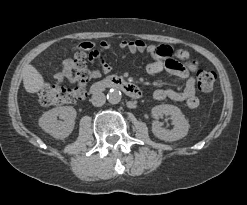 Multiple Bypass Grafts to the Lower Extremities - CTisus CT Scan