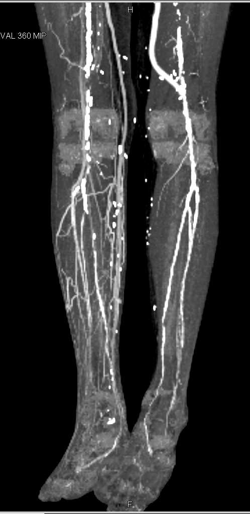 CTA Runoff with Peripheral Vascular Disease - CTisus CT Scan