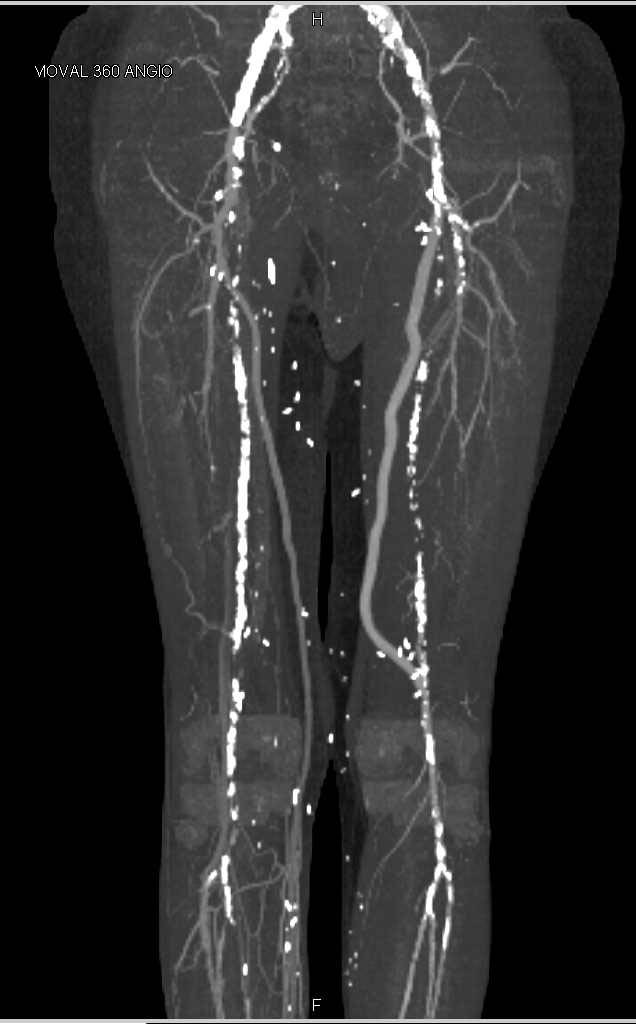 CTA Runoff with Peripheral Vascular Disease and Bypass Grafts - CTisus CT Scan