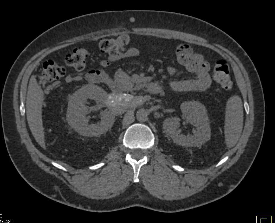 Unusual Case of Retroperitoneal Fibrosis Involves the Aorta and Inferior Vena Cava (IVC) - CTisus CT Scan