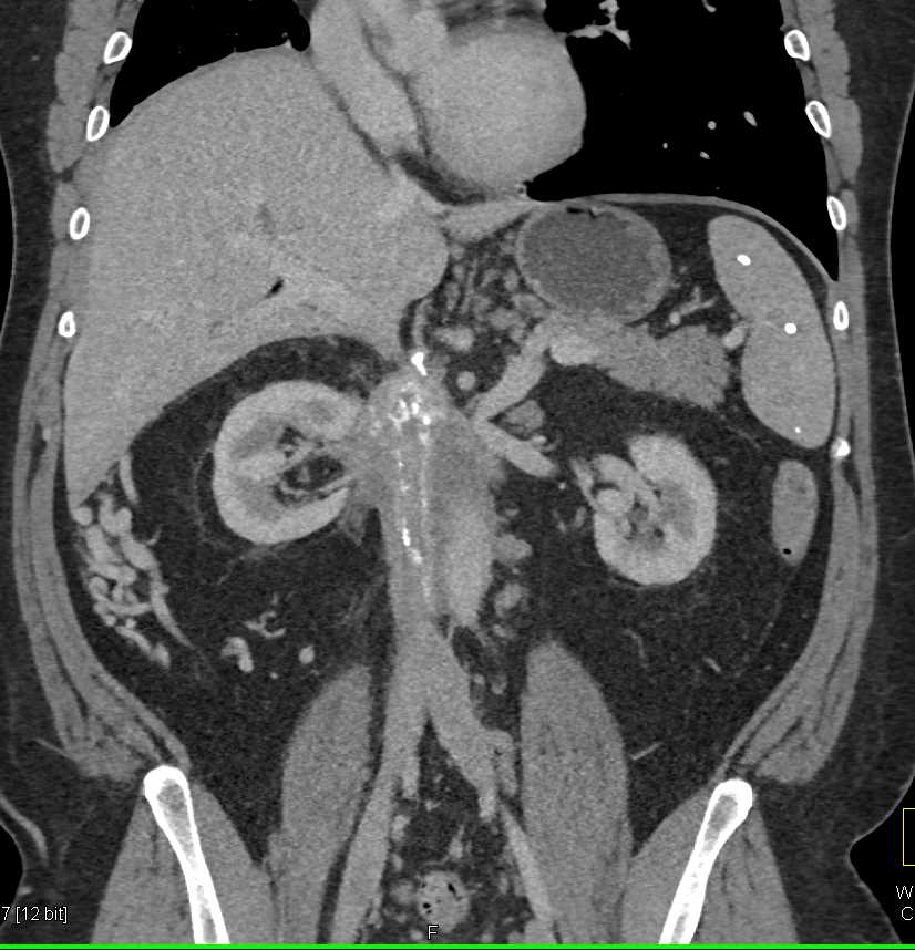 Unusual Case of Retroperitoneal Fibrosis Involves the Aorta and Inferior Vena Cava (IVC) - CTisus CT Scan