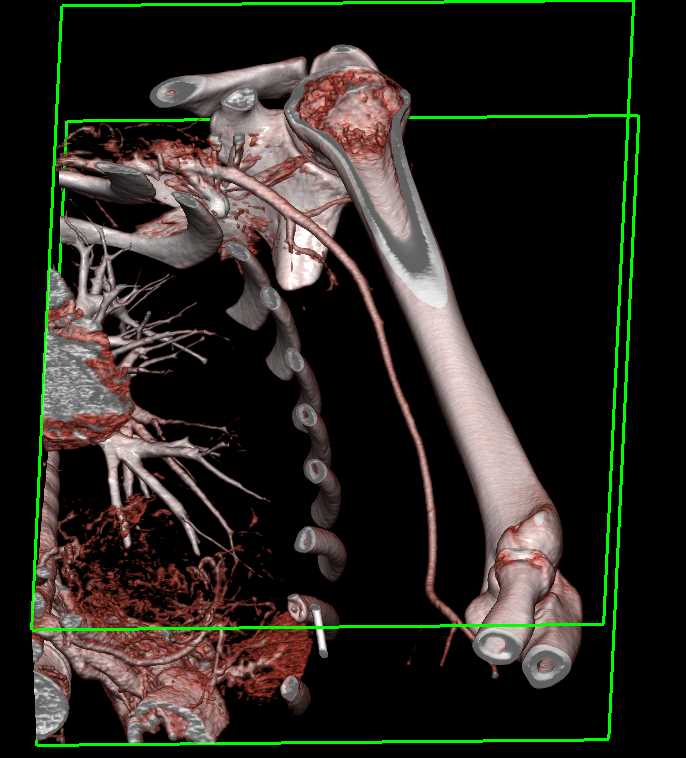 GSW Axilla Without Vascular Injury on the CTA - CTisus CT Scan