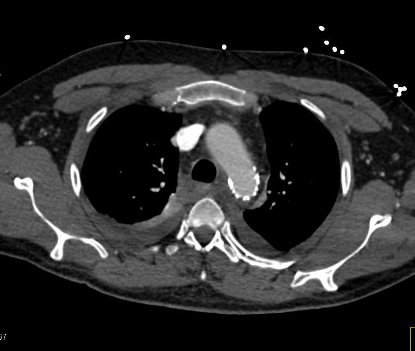 Endovascular Stent in Arch Following Motor Vehicle Accident (MVA) with Trauma - CTisus CT Scan