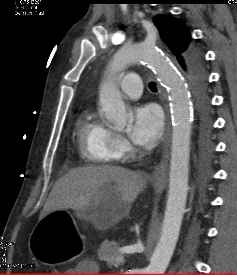 Endovascular Stent in Arch Following Motor Vehicle Accident (MVA) with Trauma - CTisus CT Scan