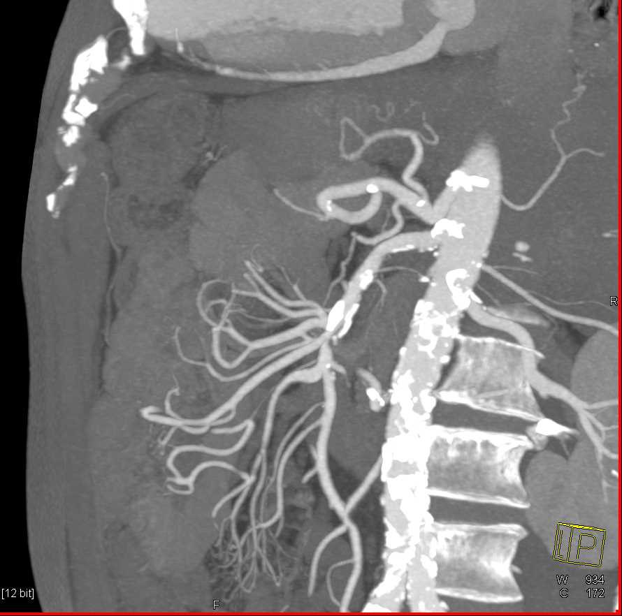 Stenosis in Superior Mesenteric Artery (SMA) Branches - CTisus CT Scan