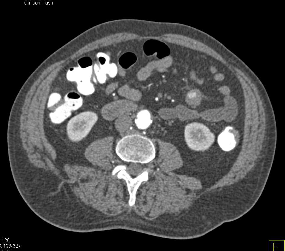 Bleeding Pseudoaneurysm off Jejunal Branches - CTisus CT Scan