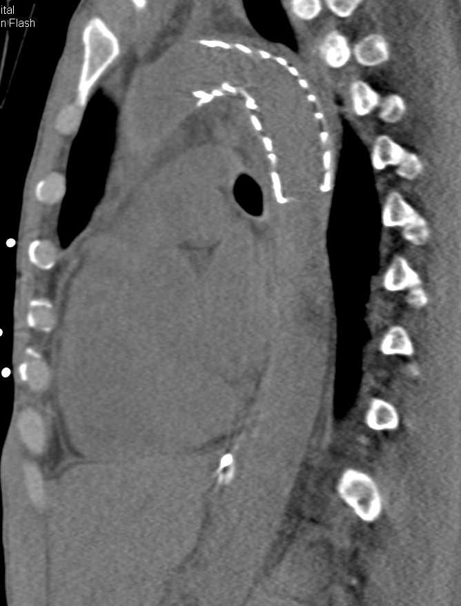 Endovascular Stent in Thoracic Aorta - CTisus CT Scan