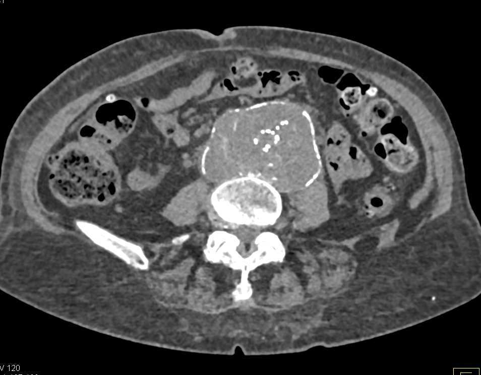 Endoleak Type 2 Abdominal Aorta - CTisus CT Scan