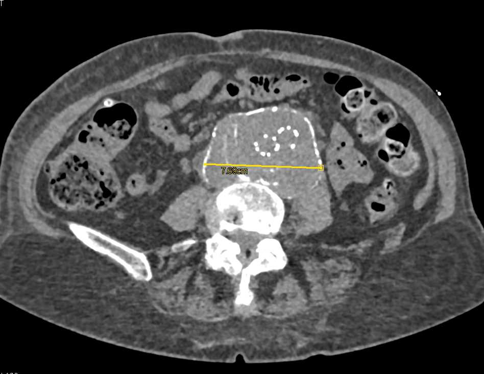 Ulceration Thoracic Aortic Aneurysm and Endoleak Abdominal Aorta Aneurysm Post Repair - CTisus CT Scan