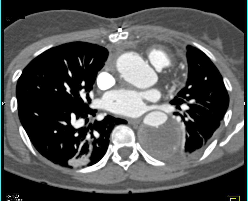 Aortic Dissection Involves Repair of Ascending Aorta and Dissection Distally - CTisus CT Scan