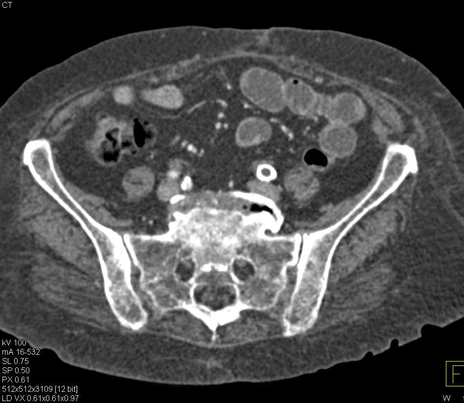 Occlusion Left Iliac Stent and Occlusion of Right Iliac Vasculature as Well - CTisus CT Scan