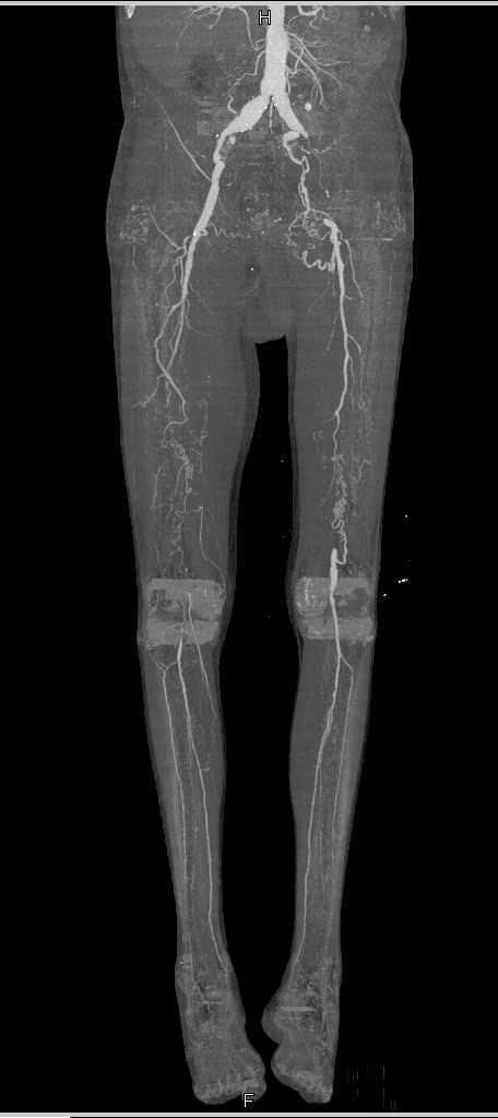 Vascular Map with Multiple Vascular Stenosis - CTisus CT Scan