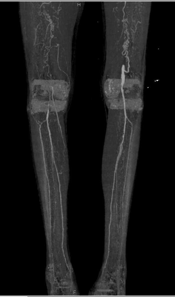 Occlusion of the Superficial Femoral Arteries Bilaterally - CTisus CT Scan